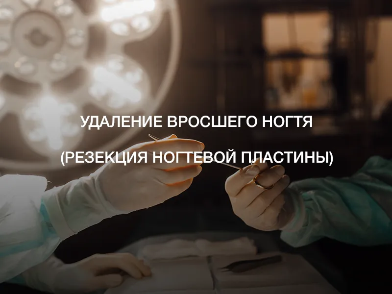Удаление вросшего ногтя (резекция ногтевой пластины) Удаление вросшего ногтя (резекция ногтевой пластины)
