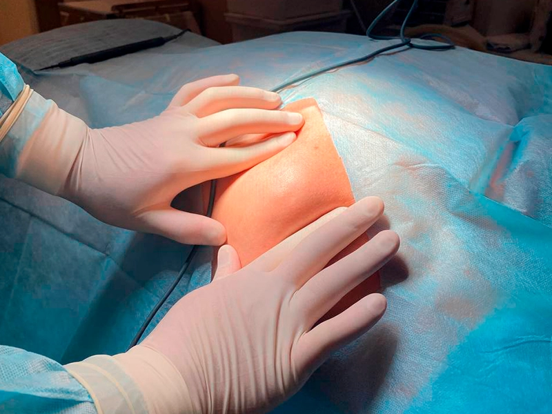 Удаление липомы  - До